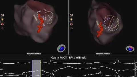 Cavotricuspid Flutter Ablation using AcQMap®