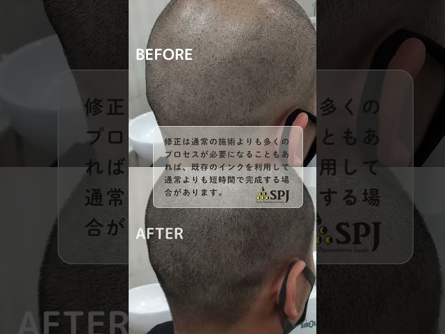 他店修正【SMPに類似する様々な頭皮カモフラージュが存在します。国内外の修正例多数。どの様なお悩みもまずはお気軽にご相談ください。】※既存のインク濃度が高い場合、動画の様に仕上りが濃い目になります。