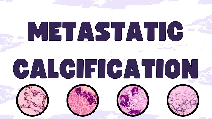Metastatic Calcification