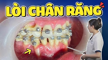 Dấu Hiệu Tiêu Xương Khi Niềng Răng: Như Thế Nào Là Tiêu Xương Bất Thường? Làm Sao Để Phòng Tránh?