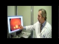 Degeneración Macular