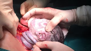 Umbilical Cord Around Baby Neck, Cord Compression, & HIE