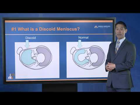 Discoid Meniscus Injuries | FAQ with Dr. R. Jay Lee