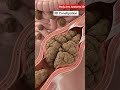 Severe stool Impaction and obstruction in the rectum  | Gut Health | Body Arts Anatomy 3D