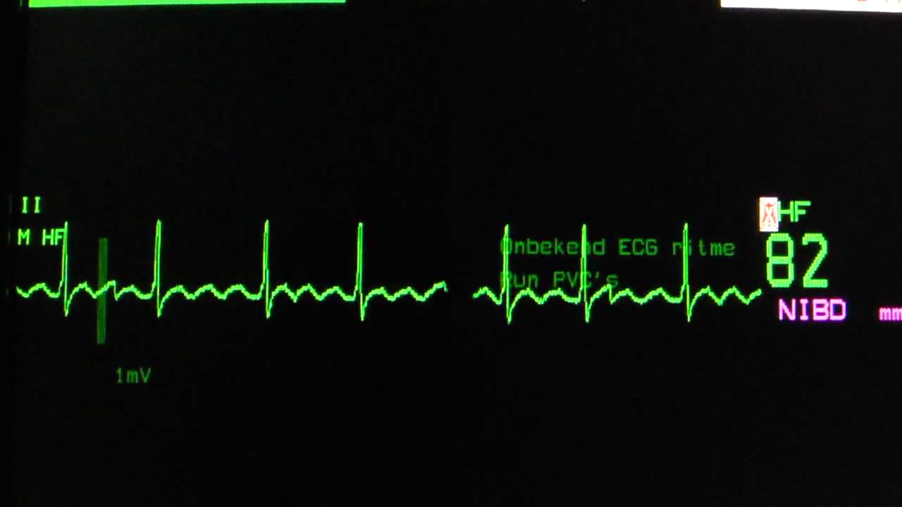 Atrial Flutter On An ECG Heart Monitor YouTube atrial-flutter-on-an-ecg-heart-monitor-youtube