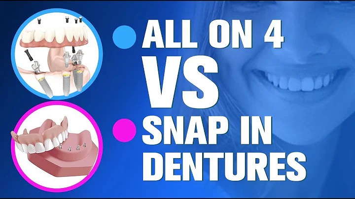 All-on-4 vs Snap in Dentures! WHO WINS?  All-on-4 dental implants OR Snap in Dentures procedure?