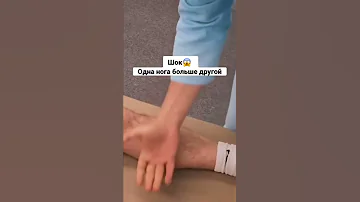 Нога короче другой😱 | Разная длина ног, одна нога больше другой #костоправ #плоскостопие #shorts