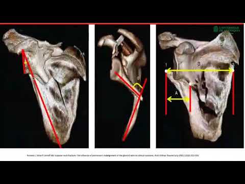 Video: ¿Puedes fracturarte la escápula?