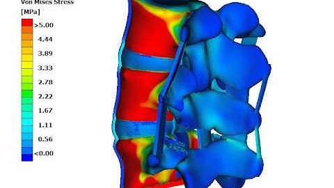 Facectomy in an L3-L5 lumbar spine segment