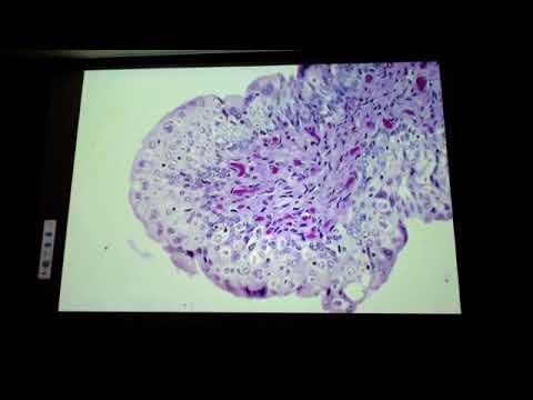 Video: Gastrointestinal Disease (Helicobacter Mustelae) Sa Ferrets