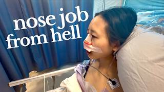 i got nose surgery (rhinoplasty + septoplasty) and it was the most painful experience of my life