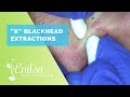 Blackhead Extractions on “K” #10