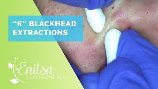 Blackhead Extractions on “K” #10