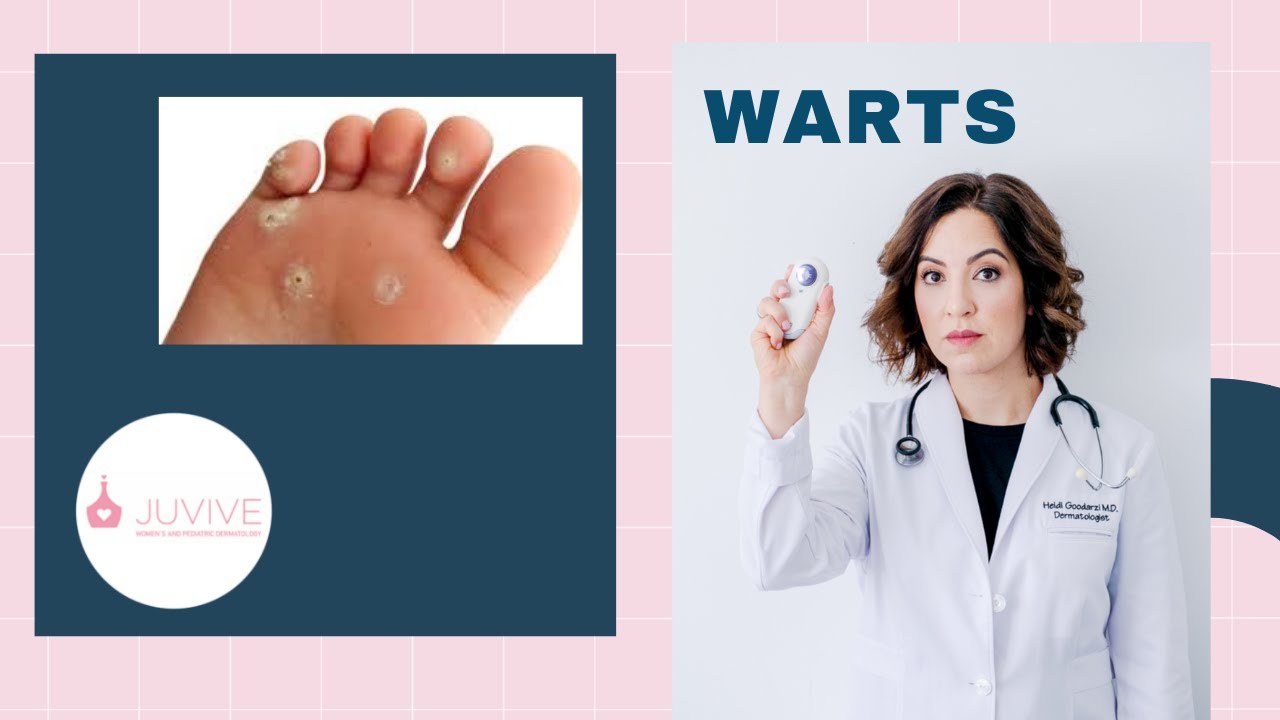 Dermatologist explains best wart treatments at home YouTube
