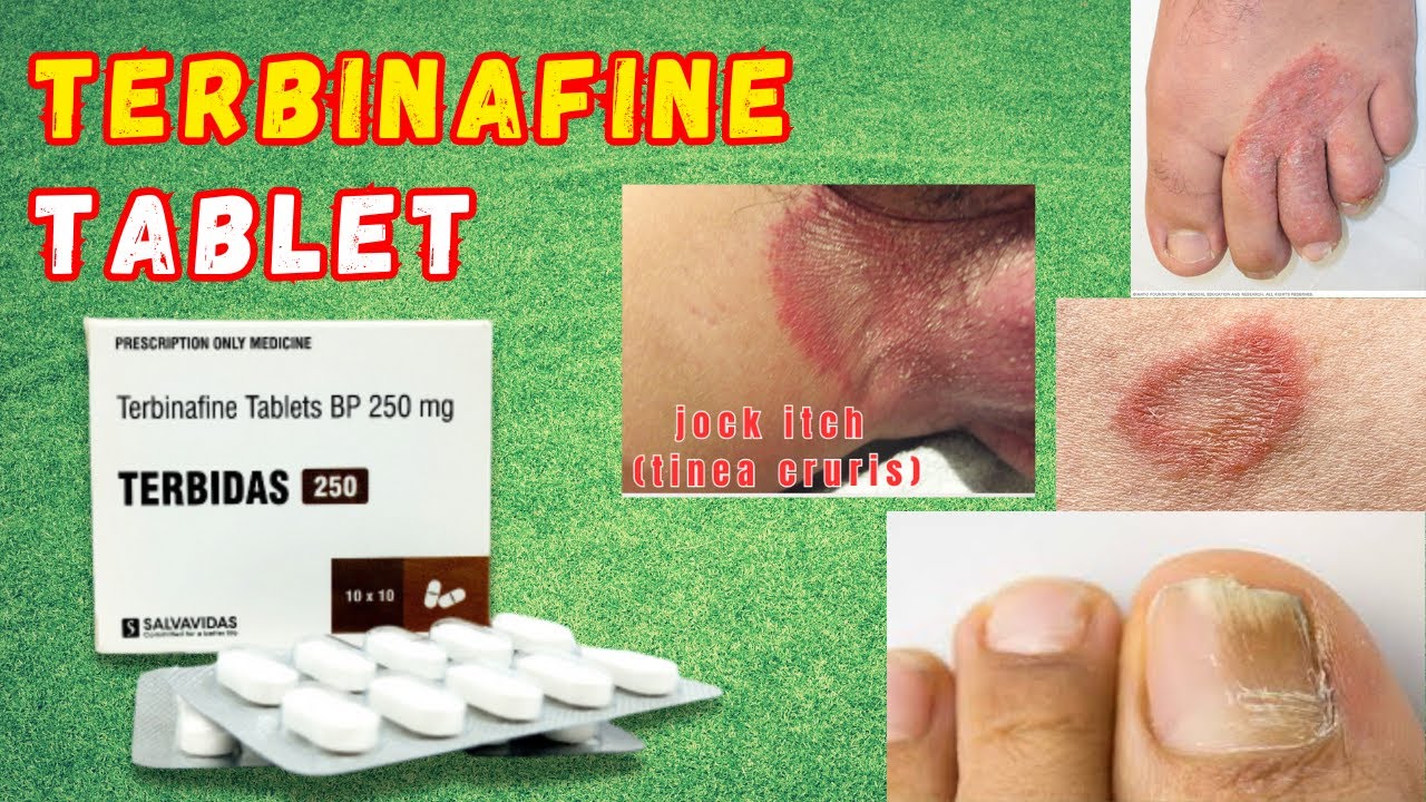 Terbinafine Tablet  Terbinafine Antifungal Drug  Terbinafine Tablets ip 250 mg