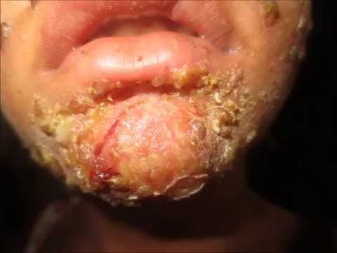 Crusts On Face - Impetigo Contagiosa