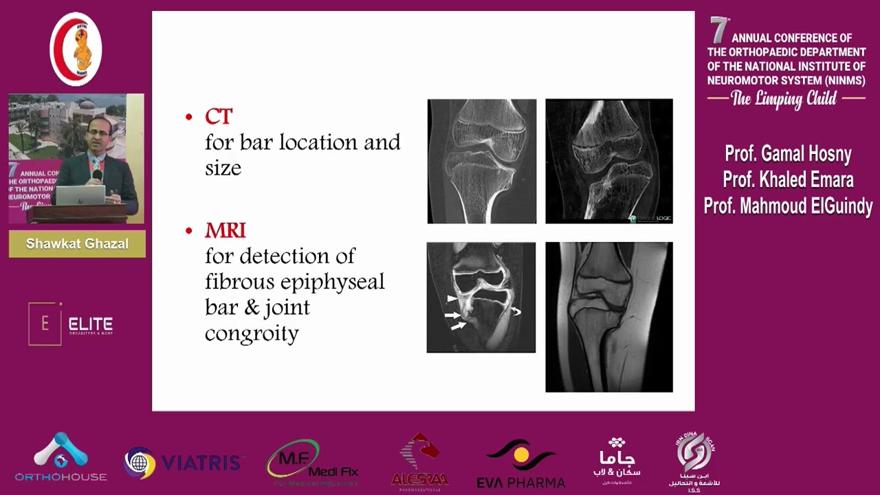 Day 2 session 1.1 Blount' disease managment- Shawkat Ghazal