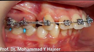 تصحيح بروز الأسنان العلوية من خلال القلع على الفك العلوي فقط - الدكتور محمد يونس حجير