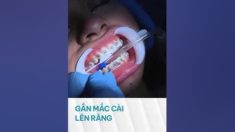 Cận cảnh gắn mắc cài lên răng - Peace Dentistry #shorts