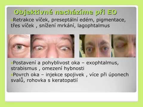 Video: Ochorenia Očí U Mačiek: Exophthalmos, Enophthalmos A Strabizmus