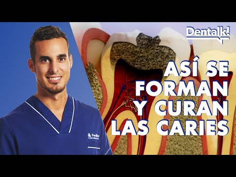 Video: Cómo evitar que una caries empeore (con imágenes)