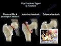 Hip Fracture Types & Fixation - Everything You Need To Know - Dr. Nabil Ebraheim