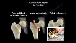 Hip Fracture Types & Fixation - Everything You Need To Know - Dr. Nabil Ebraheim