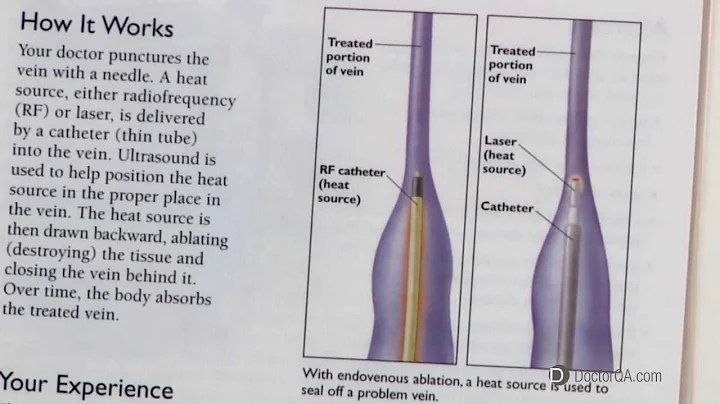 What does Endovenous Laser Ablation EVLA feel like...