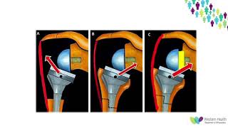 OrthoFracs Reverse Total Shoulder Replacement Complications by Dr. James Drummond