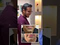 شفط دهون اللغد وتحديد الفك ببنج موضعي 