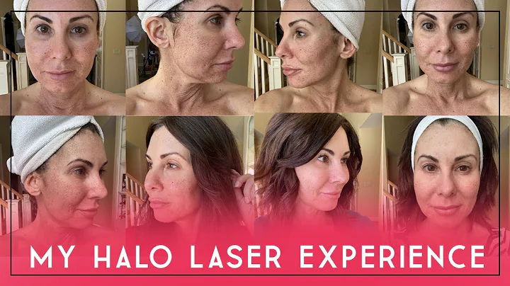 Min HALO Laser-upplevelse | Daglig återhämtning | Var det värt det?