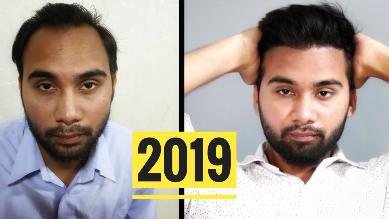 Prabhat Nawani Hair Transplant 2019 || FUE Hair Transplant Result - YouTube