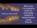 Mirroring Contralateral Tooth for Immediate Implant & Temporary Anterior Tooth | Exocad Tutorial