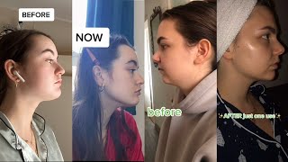 Gua sha Amazing Results Before and After Tiktok Compilation (SHOCKING)