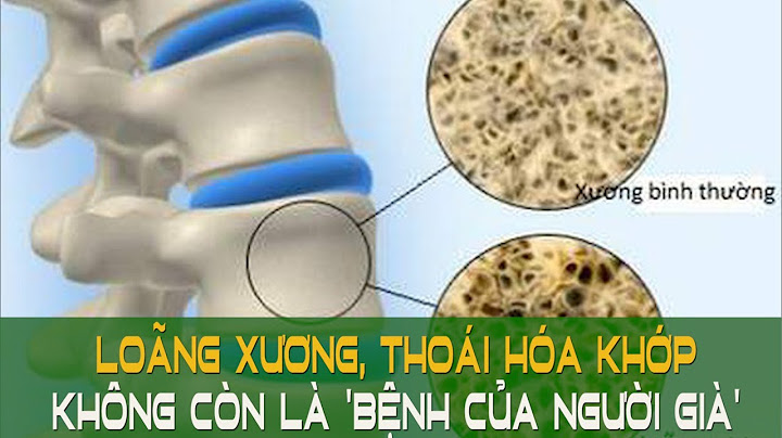 Thuốc thoái hóa khớp có ảnh hưởng tới mắt không năm 2024