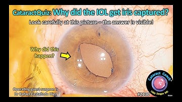 CataractCoach™ 2130: CataractQuiz: Why did the IOL get iris captured?