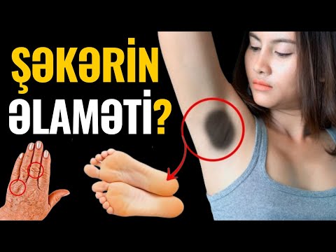 Şəkər Xəstələrinin 25%-i Bunu Bilmir - BU ƏLAMƏTİ HƏKİMLƏR GİZLƏDİR