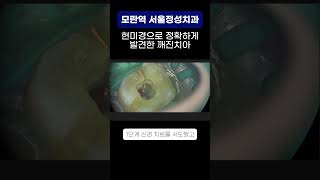 금 간 치아 발치 후 당일 임플란트 #모란임플란트