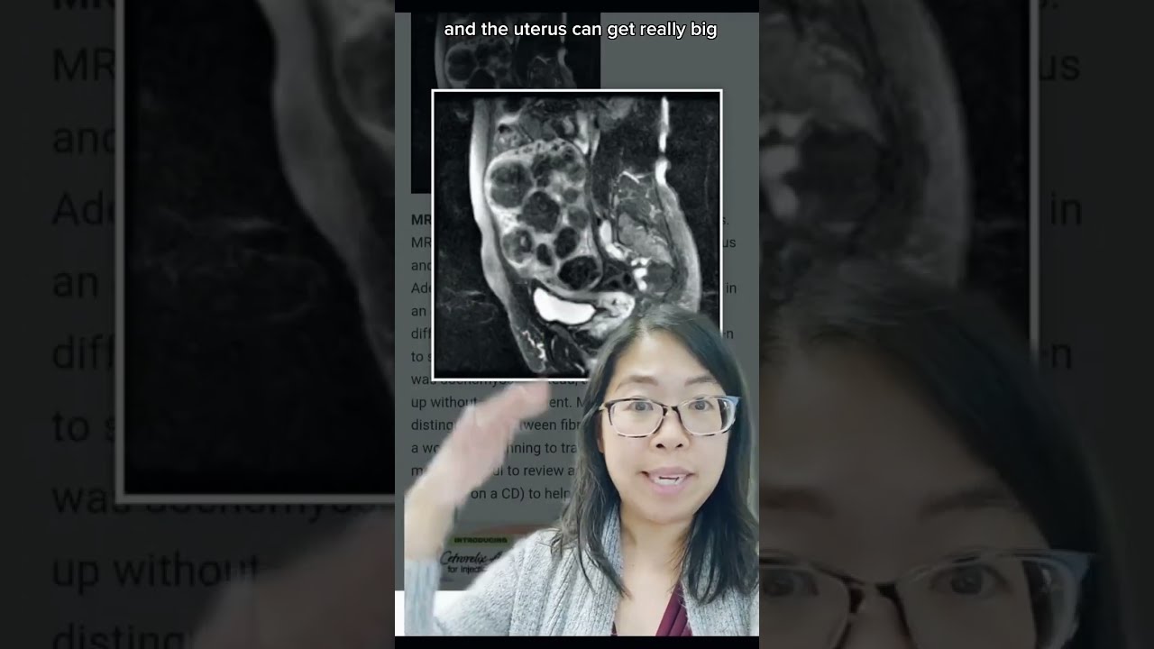 What happens to the *space* where the uterus was after a HYSTERECTOMY? Gynecologist Explains! #short