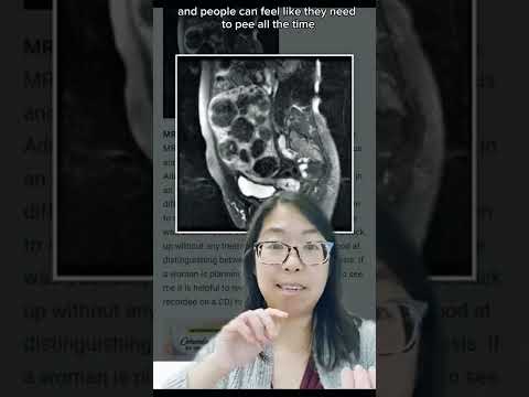 Video: Pob hysterectomy kho pmdd?