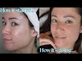 SKIN UPDATE #7: 2 Years 0.1% Tretinoin, CO2 Fraxel Laser 1.5 Years Later, New Approach to Skincare