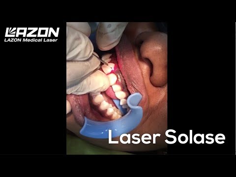 Laser Solase - Alongamento da Coroa