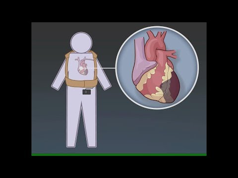 Video: Arytmické Epizódy U Pacientov S Implantovaným Kardioverter-defibrilátorom - Výsledky Z Prospektívnej štúdie O Predikčnej Kvalite S Terapiou ATP Bez Predvoľby Bolesti Bez Bolesti (4