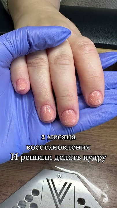 Аллергия на гель-лак / онихолизис / покрытие без лампы / титановые ...