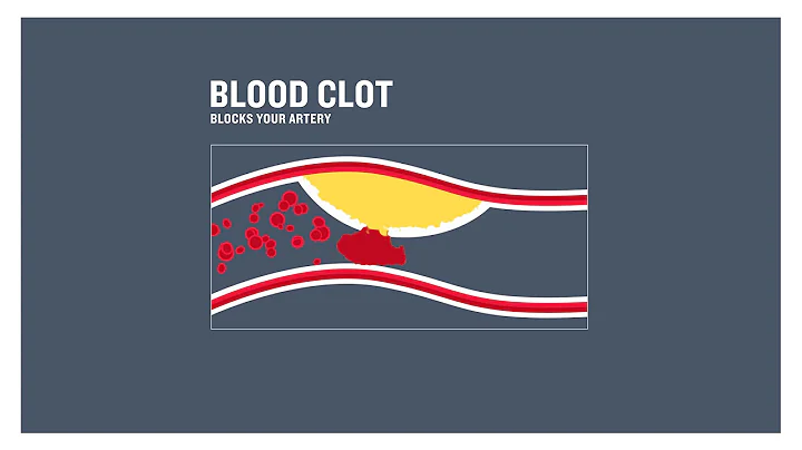 Coronary heart disease, clogged arteries and atherosclerosis - DayDayNews