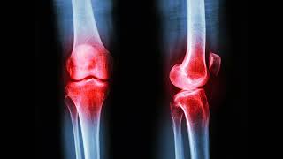Could GLP-1 Medications Offer a New Path for Arthritis Treatment?