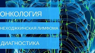 НЕХОДЖКИНСКАЯ ЛИМФОМА - диагностика на 1,2,3,4 стадии