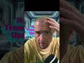 Day 28 Post Hair Transplant Update -Still losing hair with a number of bald spots now@PapaBestNick