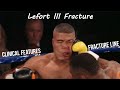 Lefort 3 Fracture | Craniofacial Dysjunction | Fracture Lines | Dr Bhaumik Joshi | Aspire MDS