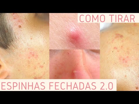 COMO RETIRAR ESPINHAS INTERNAS E EXTERNAS 2 0 - Bruna Harmel